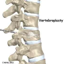 Vertebroplasty and Kyphoplasty
